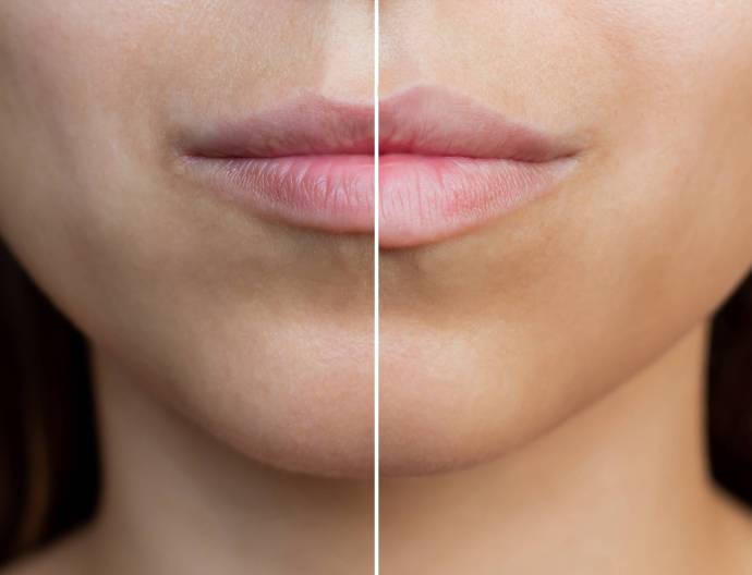 cropped-shot-young-womens-face-with-lips-before-after-lip-enhancement-injection-filler